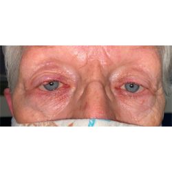 Lesion Removal Before & After Patient #355