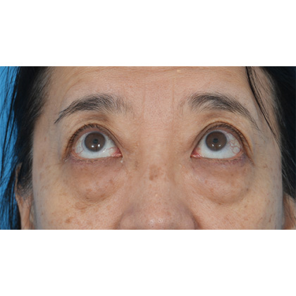 Lower Blepharoplasty Before & After Patient #521