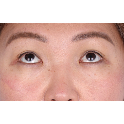 Lower Blepharoplasty Before & After Patient #523