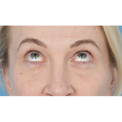 Lower Blepharoplasty Before & After Patient #861