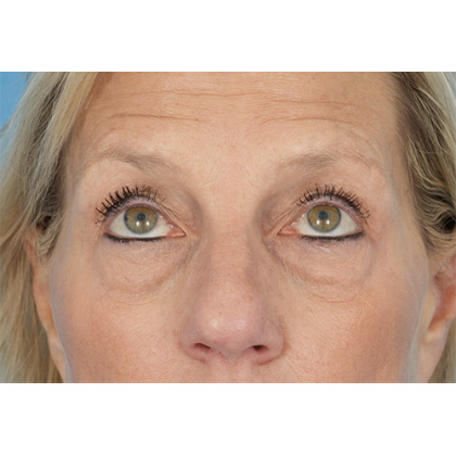 Four Lid Blepharoplasty Before & After Patient #400
