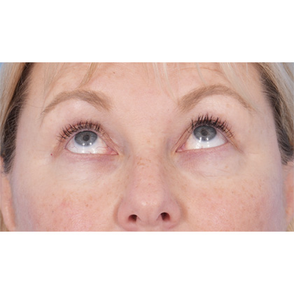 Four Lid Blepharoplasty Before & After Patient #416