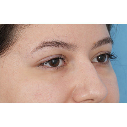 Lower Blepharoplasty Before & After Patient #520