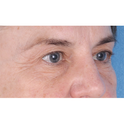 Four Lid Blepharoplasty Before & After Patient #398