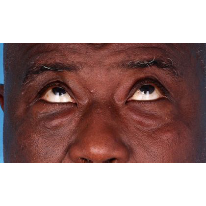 Four Lid Blepharoplasty Before & After Patient #395