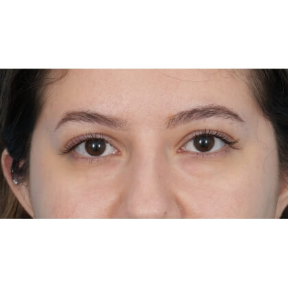 Lower Blepharoplasty Before & After Patient #520