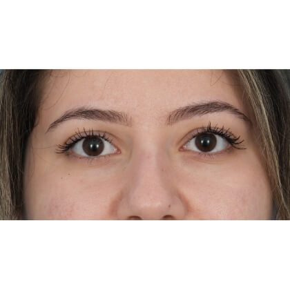 Lower Blepharoplasty Before & After Patient #520