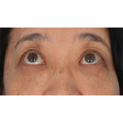 Lower Blepharoplasty Before & After Patient #521