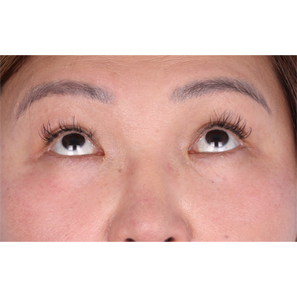 Lower Blepharoplasty Before & After Patient #523