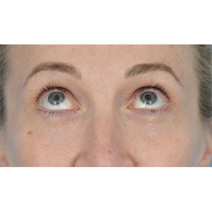 Lower Blepharoplasty Before & After Patient #861