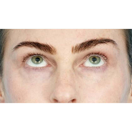 Lower Blepharoplasty Before & After Patient #539