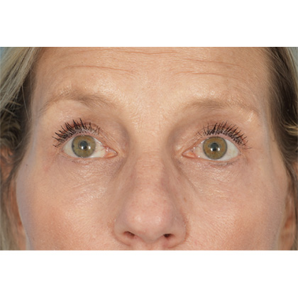 Four Lid Blepharoplasty Before & After Patient #400