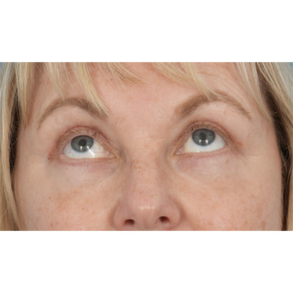 Four Lid Blepharoplasty Before & After Patient #416