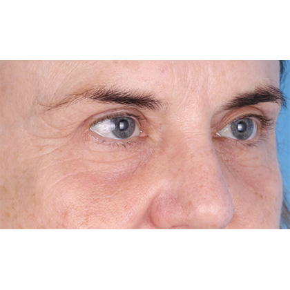 Four Lid Blepharoplasty Before & After Patient #398