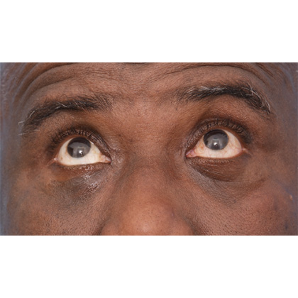Four Lid Blepharoplasty Before & After Patient #395