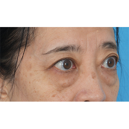 Lower Blepharoplasty Before & After Patient #521