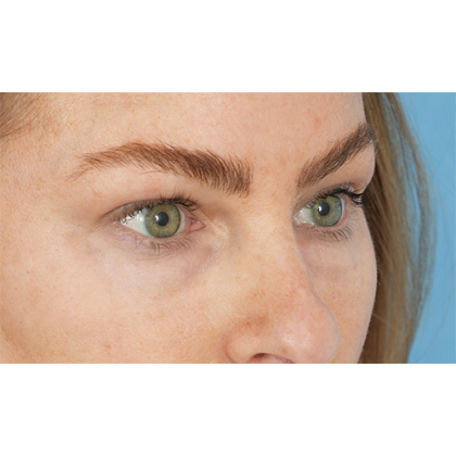 Lower Blepharoplasty Before & After Patient #539