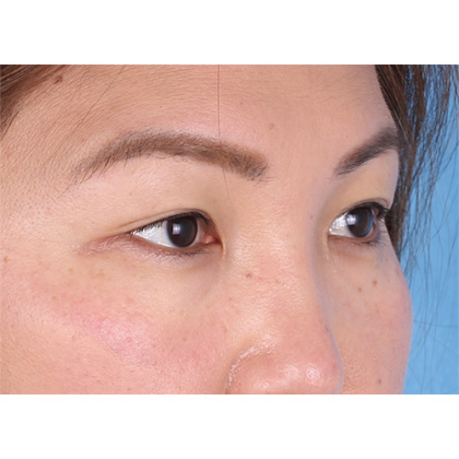 Lower Blepharoplasty Before & After Patient #523