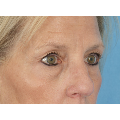 Four Lid Blepharoplasty Before & After Patient #400