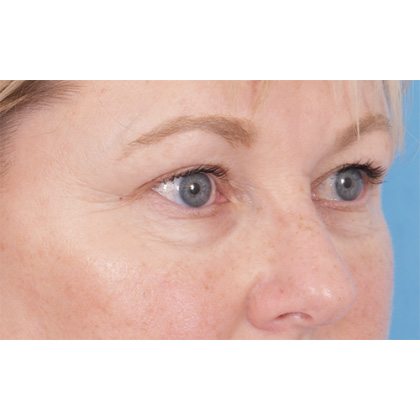 Four Lid Blepharoplasty Before & After Patient #416