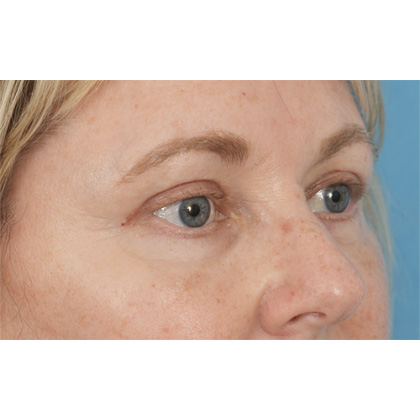 Four Lid Blepharoplasty Before & After Patient #416