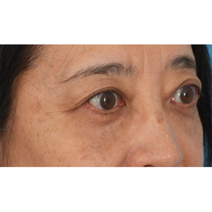 Lower Blepharoplasty Before & After Patient #521