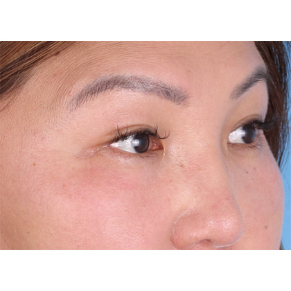 Lower Blepharoplasty Before & After Patient #523