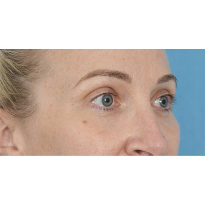 Lower Blepharoplasty Before & After Patient #861