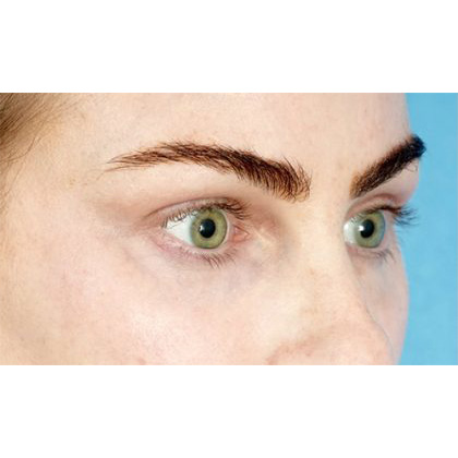 Lower Blepharoplasty Before & After Patient #539