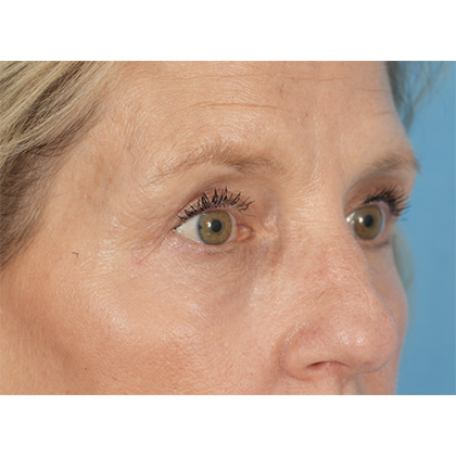 Four Lid Blepharoplasty Before & After Patient #400