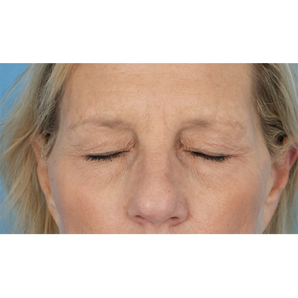 Four Lid Blepharoplasty Before & After Patient #400