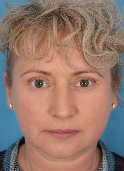Four Lid Blepharoplasty Before & After Patient #393
