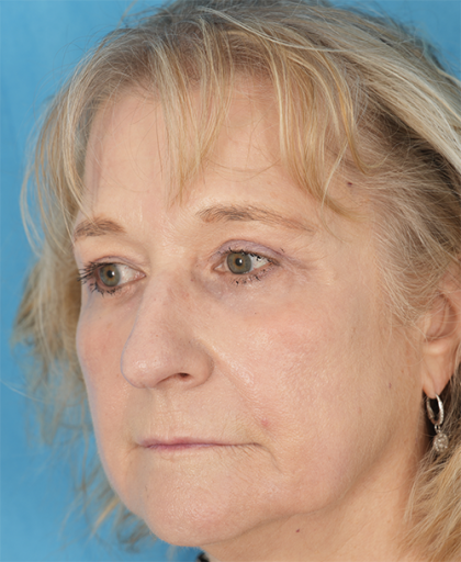 CO2 Laser Resurfacing Before & After Patient #392