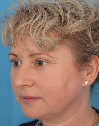 Four Lid Blepharoplasty Before & After Patient #393