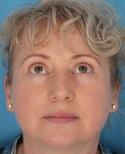 Four Lid Blepharoplasty Before & After Patient #393