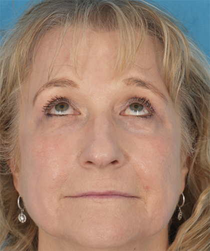 CO2 Laser Resurfacing Before & After Patient #392