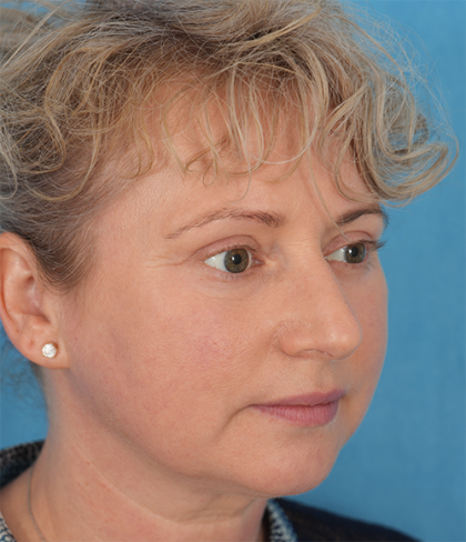 Four Lid Blepharoplasty Before & After Patient #393
