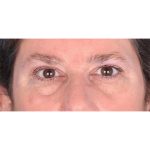 Brow Lift Before & After Patient #336