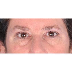 Brow Contour Before & After Patient #336