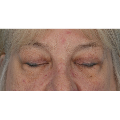 Upper Blepharoplasty Before & After Patient #728