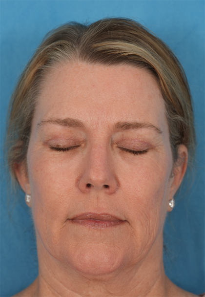 Four Lid Blepharoplasty Before & After Patient #394