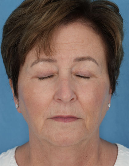 Four Lid Blepharoplasty Before & After Patient #401