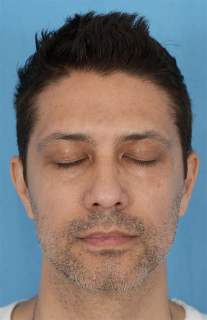Lower Blepharoplasty Before & After Patient #527