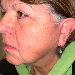 Facelift Before & After Patient #387