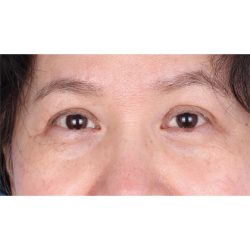 Lesion Removal Before & After Patient #353