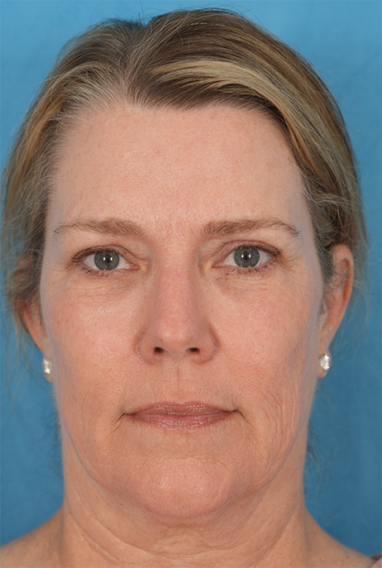 Four Lid Blepharoplasty Before & After Patient #394