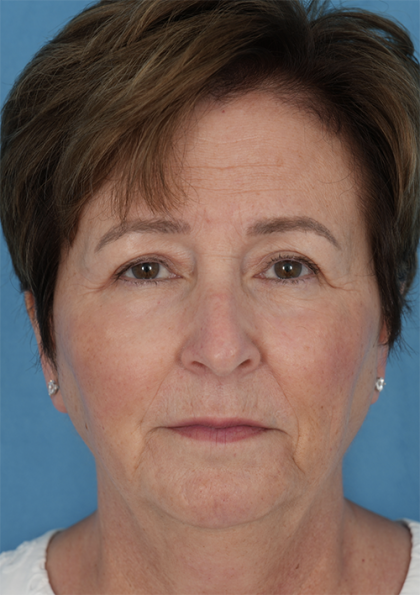 Four Lid Blepharoplasty Before & After Patient #401