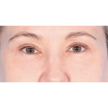Four Lid Blepharoplasty Before & After Patient #399
