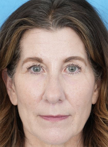 Lower Blepharoplasty Before & After Patient #525