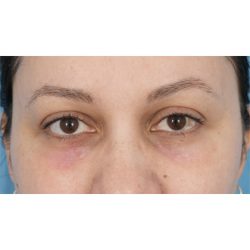 Lesion Removal Before & After Patient #359